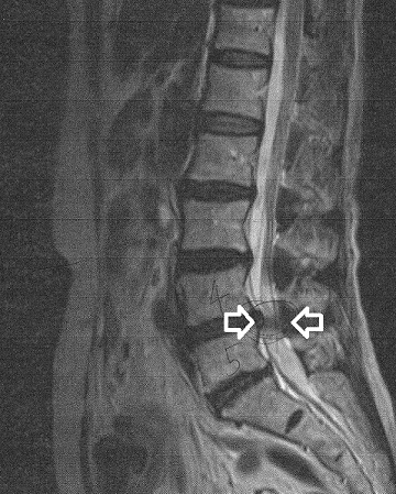 脊柱管狭窄症MRI